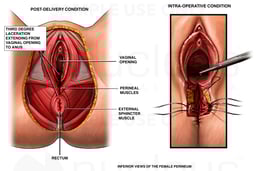 Third Degree Episiotomy Tear with Surgical Repair