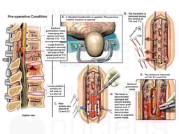 Third Spine Surgery (Part 1): Surgical Decompression and Stabilization of Pseudoarthrosis
