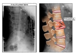 Lumbar Spine Injury