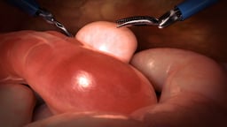 Robotic Radical Cystectomy (Male)