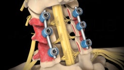 Posterior Cervical Laminectomy and Fusion