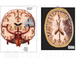 Occlusion of the Left Middle Cerebral Artery