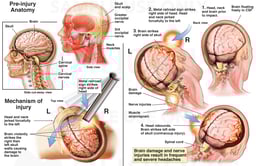 Mechanism of Head Injury