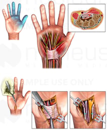 Carpal Tunnel Syndrome and Surgical Release: Right Hand
