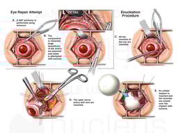 Surgeries on Ruptured Globe of Left Eye