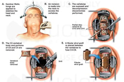 Cervical Spine Injury - C4-5, C5-6 Herniated Discs with Anterior Discectomy and Spinal Fusion Surgery