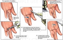 Attempts to Salvage the Fourth Finger