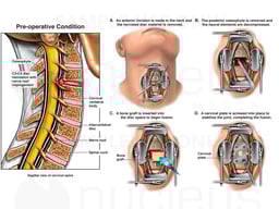 C3-4 Disc Herniation with Anterior Discectomy