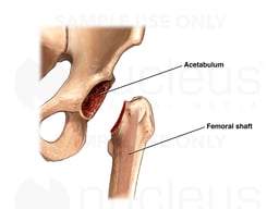 THR: Preparation of Acetabulum and Femur