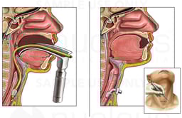 Classic Intubation and Tracheostomy Procedures