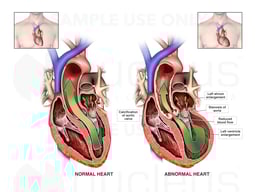 Critical Aortic Stenosis