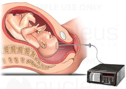 Intracranial Fetal Monitor Device