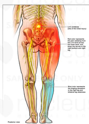 Lumbar Spine Injury with Radiating Pain