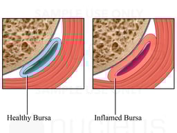 Cut-away View of Inflamed Bursa
