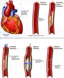 Coronary Artery Stenosis with Angioplasty