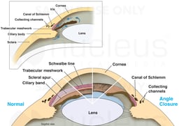 Primary Glaucoma