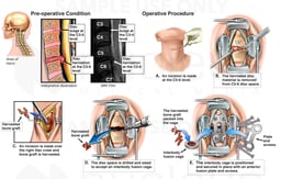 Cervical Spine Injury with Surgical Discectomy and Fusion