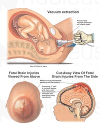Vacuum Extraction Delivery with Fatal Head Injuries