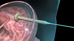 Pull Method of Percutaneous Endoscopic Gastrostomy (PEG)
