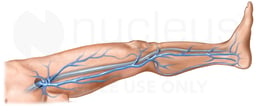 Deep Vein Thrombosis (DVT)