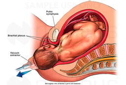 Birth Injury - Shoulder Dystocia Using Vacuum Extractor Delivery