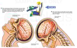 Whiplash - Coup and Contrecoup Closed Head Injury