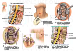 C5-6 Disc Herniation with Discectomy and Spinal Fusion