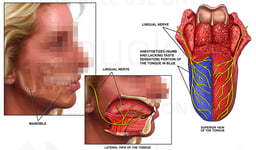 Intra-operative Injury of the Lingual Nerve with Partial Anesthetization of the Tongue