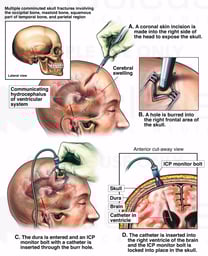 Brain Surgery - Ventriculostomy and Placement of Intracranial Pressure (ICP) Monitor Bolt