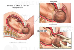 Shoulder Dystocia with Brachial Plexus Injury