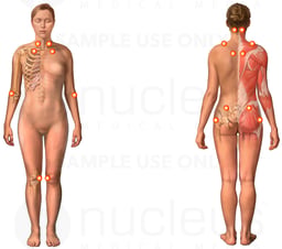 Fibromyalgia Syndrome (Female)