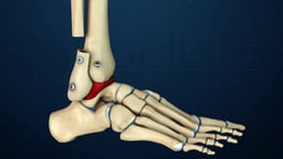 Lateral Transfibular Ankle Fusion