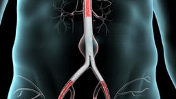 Endovascular Abdominal Aortic Aneurysm Repair: Stent Graft 