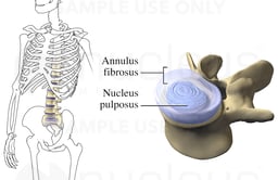 Intervertebral Disc