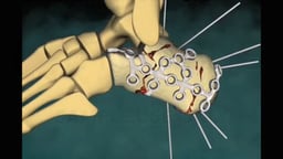 Bilateral Calcaneus Fractures and Open Reduction Internal Fixation Procedures