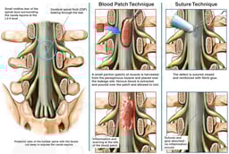 Progression of Lumbar Condition