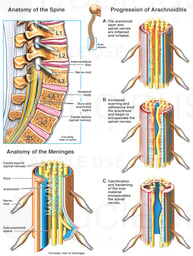 Arachnoiditis of the Lumbo-sacral Spine
