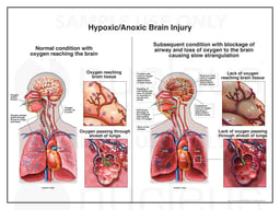 Hypoxic/Anoxic Brain Injury