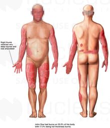 Front and Back Male Figures with Post-accident Burn Injuries