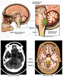 Choroid Plexus Papilloma - Fourth Ventricle