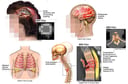Female with Scalp Laceration, Underlying Brain INjury, Thoracic Vertebral Fracture and Spinal Cord Injury