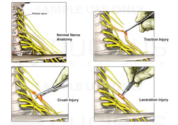 Mechanism of Nerve Injury