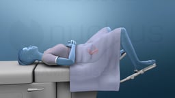 Patient in Dorsal Lithotomy Position for Pelvic Exam