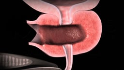 Open Prostatectomy for Benign Prostatic Hyperplasia (BPH) 