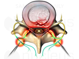 L4-5 Disc Bilateral Rhizotomy
