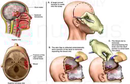 Brain Surgery - Severe Post-accident Head Injury with Removal of Blood Clot
