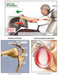 Mechanism of Shoulder Injury