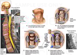 Cervical Spine Injuries with Double Level Discectomy and Fusion