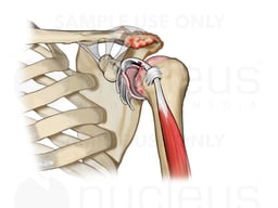 Chondromalacia of Humeral Head in the Arm