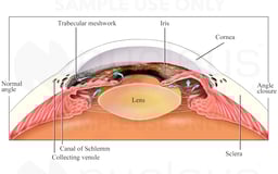 Eye Anatomy - Angle Closure within the Eye